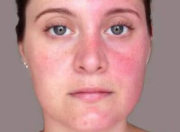 洗面奶会加重红血丝吗，怎么选择合适的洗面奶  洗面奶 美白祛黄 第3张