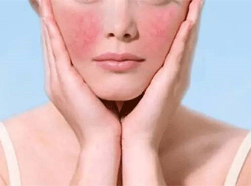 你确定你的脸只是红血丝，而不是玫瑰痤疮