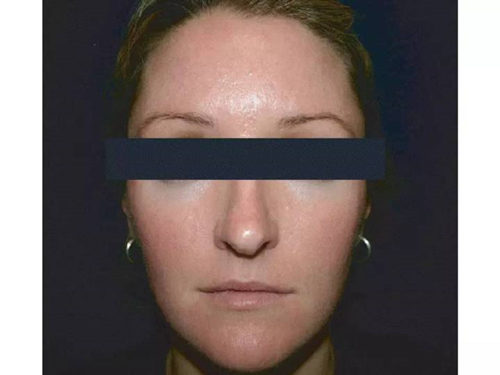 你确定你的脸只是红血丝，而不是玫瑰痤疮  玫瑰痤疮 美白祛黄 第2张