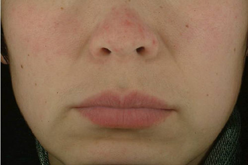 你确定你的脸只是红血丝，而不是玫瑰痤疮  玫瑰痤疮 美白祛黄 第4张