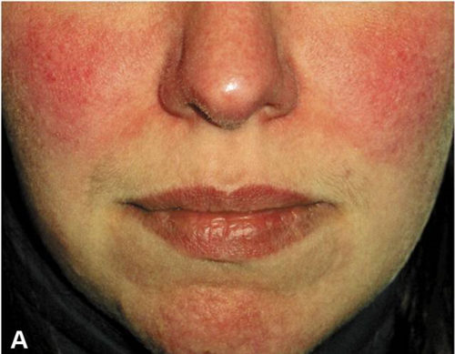 你确定你的脸只是红血丝，而不是玫瑰痤疮  玫瑰痤疮 美白祛黄 第6张