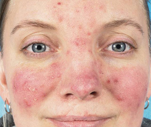 你确定你的脸只是红血丝，而不是玫瑰痤疮  玫瑰痤疮 美白祛黄 第7张