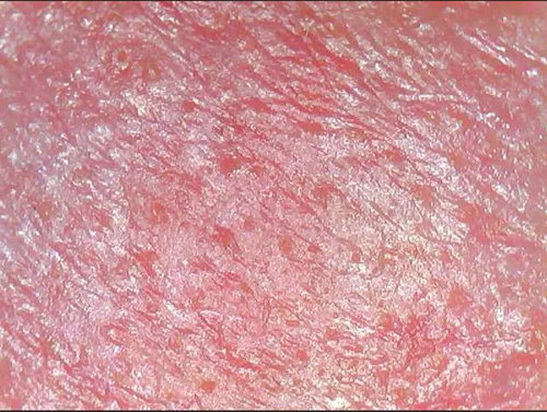 你确定你的脸只是红血丝，而不是玫瑰痤疮  玫瑰痤疮 美白祛黄 第11张