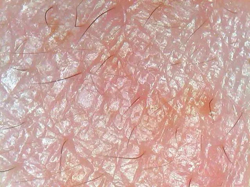 你确定你的脸只是红血丝，而不是玫瑰痤疮  玫瑰痤疮 美白祛黄 第12张