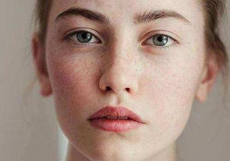 红血丝皮肤会不会长斑，有斑时该如何护理