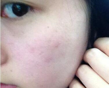 红血丝皮肤会不会长斑，有斑时该如何护理  长斑 护理 美白祛黄 第2张