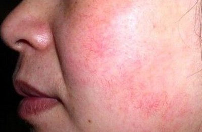 脸上有红血丝用红霉素软膏吗  红霉素 软膏 美白祛黄 第3张