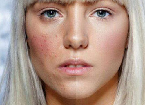 药店有去红血丝的药膏吗，  药膏 药店 美白祛黄 第2张