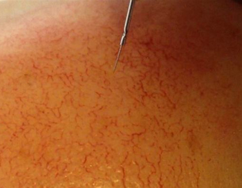 红血丝肌肤如何保养，呵护红血丝要慎重