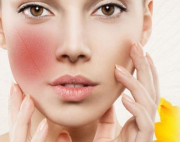 红血丝肌肤如何保养，呵护红血丝要慎重  红血丝 保养 美白祛黄 第2张