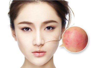 红血丝能用激光打掉吗，医美别盲目  红血丝 激光 美白祛黄 第4张