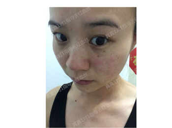 揭秘！99%的女性红血丝改善的秘诀  红血丝 秘诀 女性 美白祛黄 第3张