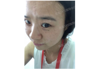 揭秘！99%的女性红血丝改善的秘诀  红血丝 秘诀 女性 美白祛黄 第4张