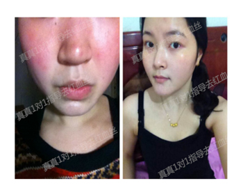 揭秘！99%的女性红血丝改善的秘诀  红血丝 秘诀 女性 美白祛黄 第7张