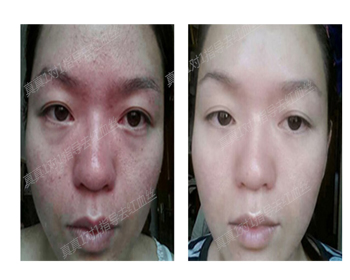 揭秘！99%的女性红血丝改善的秘诀  红血丝 秘诀 女性 美白祛黄 第8张