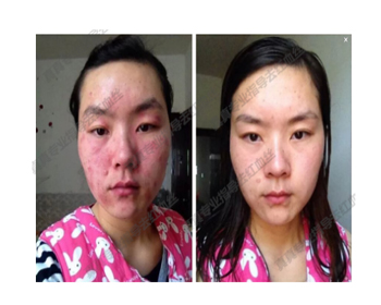 揭秘！99%的女性红血丝改善的秘诀  红血丝 秘诀 女性 美白祛黄 第9张