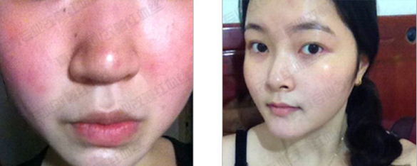 唯恩诗真真老师一对一指导去红血丝  红血丝 一对一 老师 美白祛黄 第3张