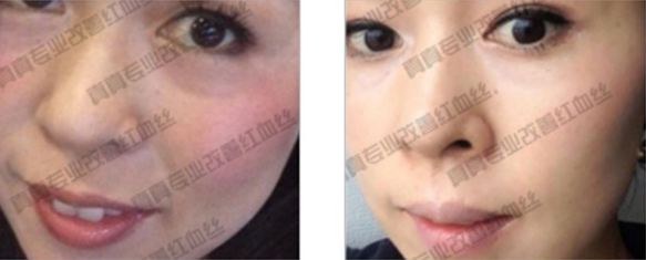 唯恩诗真真老师一对一指导去红血丝  红血丝 一对一 老师 美白祛黄 第4张