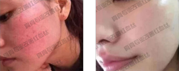 唯恩诗真真老师一对一指导去红血丝  红血丝 一对一 老师 美白祛黄 第5张