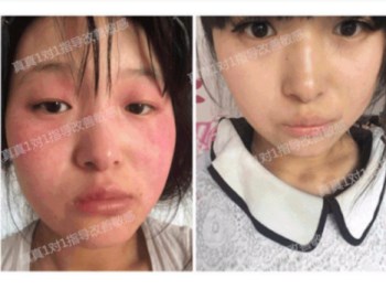 唯恩诗真真老师教你如何修复敏感肌去红血丝，安全过秋冬  红血丝 老师 美白祛黄 第3张