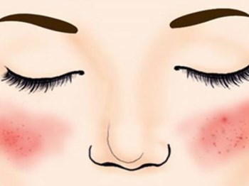 真真老师分享冬季红血丝肌肤护理方法大揭秘  红血丝 肌肤 老师 美白祛黄 第2张