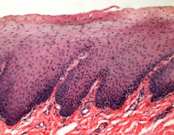 挤痘痘有红血丝怎么办，妙招帮你修复复杂肌  红血丝 挤痘 美白祛黄 第2张