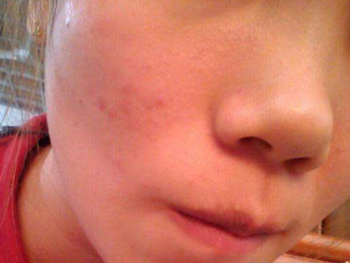 脸上红血丝痘痘怎么办，五种方法推荐