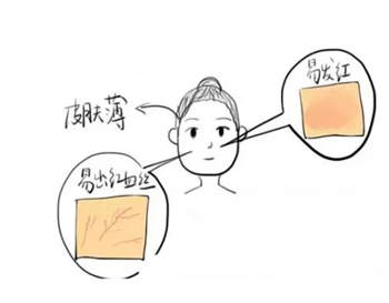 脸上红血丝可以去角质吗，去角质要慎重  去角质 红血丝 美白祛黄 第4张