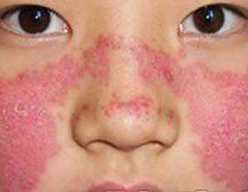 红血丝危害，了解红血丝问题严重性  红血丝 危害 美白祛黄 第5张