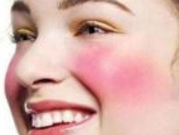 红血丝可以用烟酰胺吗，全面分析