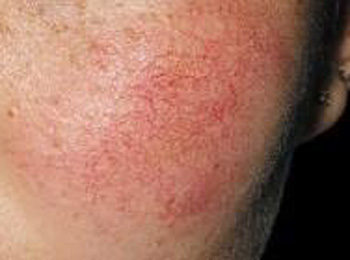 大蒜能去红血丝吗，怎样消除红血丝