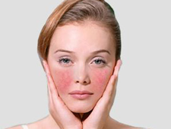 凸起来的红血丝是什么原因，怎么改善