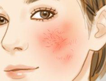 凸起来的红血丝是什么原因，怎么改善  凸起来的红血丝 美白祛黄 第2张