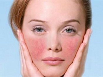 什么药治红血丝最有效，药物治疗真的有效吗