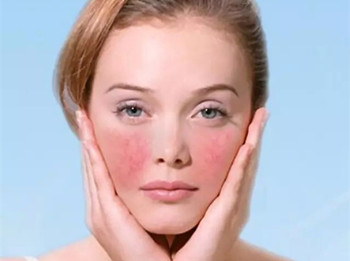 有红血丝属于什么皮肤