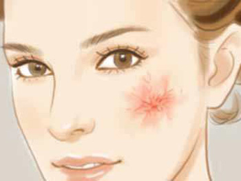 敏感肌和红血丝的区别，你必须知道的方法  红血丝 敏感肌 美白祛黄 第4张