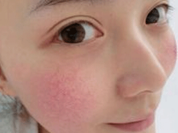 有修复好红血丝的人吗，去红心得分享