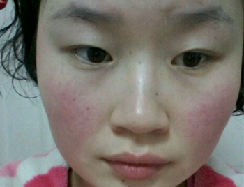 脸上有红血丝怎么处理，用什么药膏