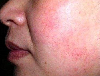 护肤品中红血丝不能用什么成分