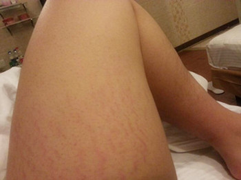 大腿有红血丝怎样治疗