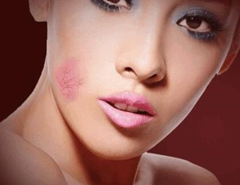 腮帮红血丝怎么调理