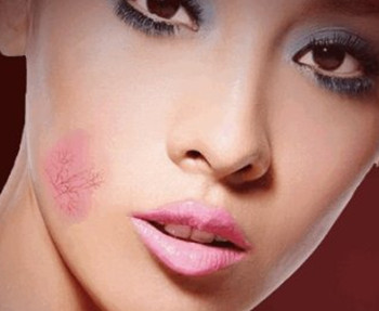 脸上起红血丝怎么去除  脸上 美白祛黄 第1张