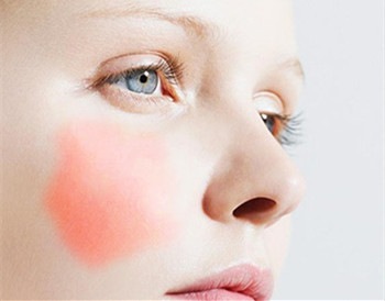 总结几个去面部红血丝的简单方法