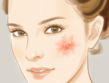 总结几个去面部红血丝的简单方法  去红血丝的方法 美白祛黄 第2张