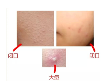 敏感肌怎么去闭口粉刺，适合哪些护肤品