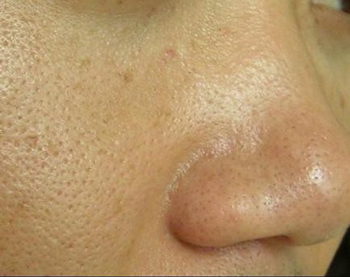 皮肤基底层缺水的症状你知道吗  基底层 症状 皮肤 美白祛黄 第5张