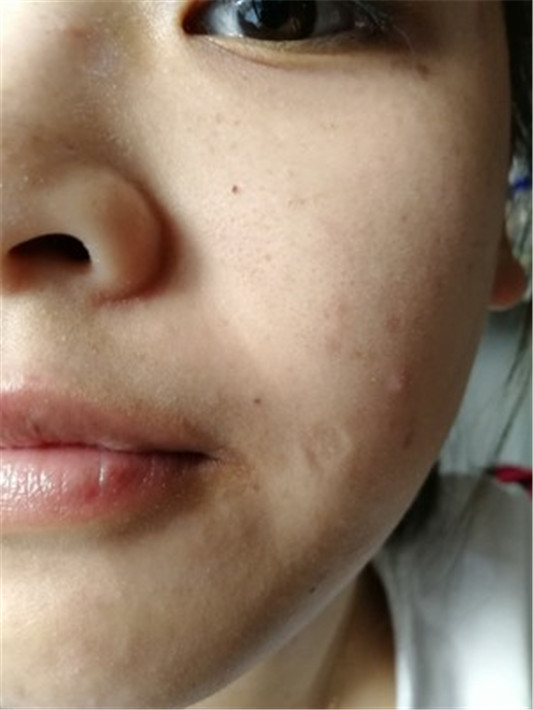 宣致蜗牛原液精华液亲身使用感受，保证是真实经历 实话实说  精华液护肤 第3张