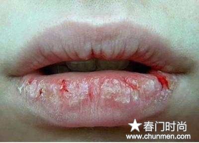 秋冬嘴唇干裂糜烂怎么回事，嘴上有裂口怎么办  嘴唇嘴唇干裂 第2张