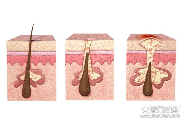 去痘去印去痘坑用化妆品效果不好，可以考虑新型医疗美容  祛痘青春痘去痘印 第1张