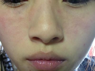 关于皮肤过敏的一些知识